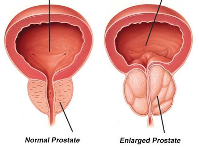Diagnosis and Treatment of Benign Prostatic Hyperplasia