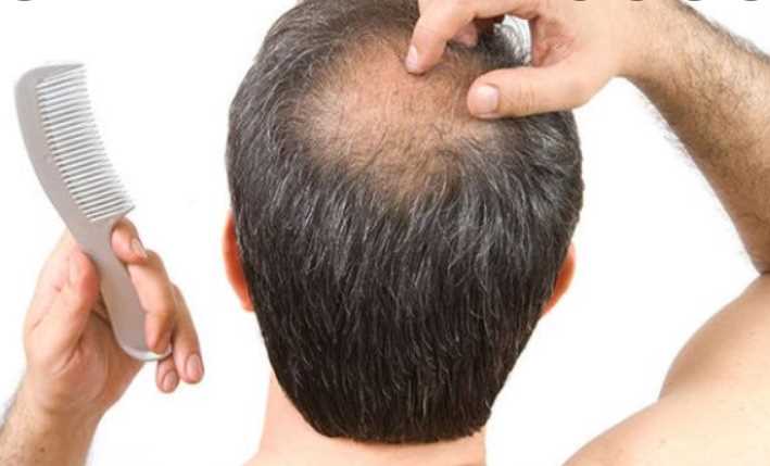 How to manage hair loss