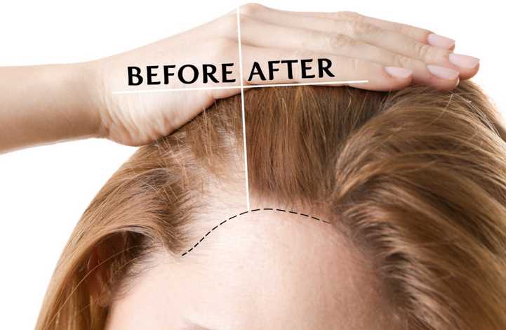 Can Women Have A Hair Transplant Treatment Done?