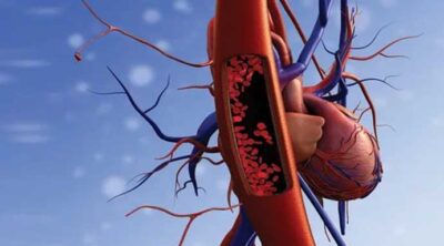 Things You Must Know About Vascular Issues