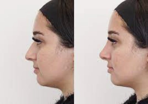 Non Surgical Nose Job Before and After – What to Expect