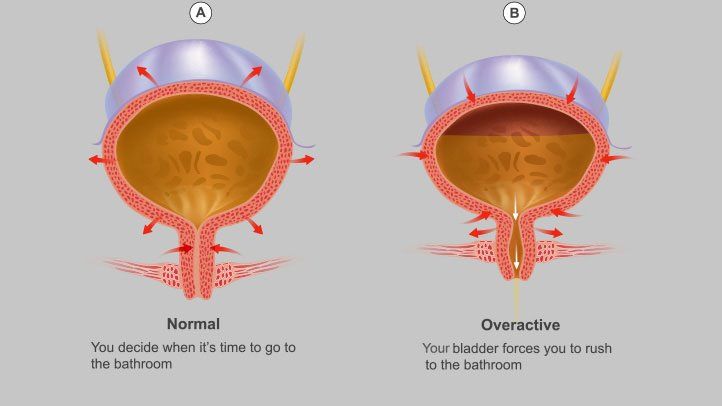 Overactive Bladder: What is it and How is it Treated?