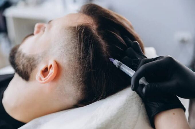 PRP Hair Treatment