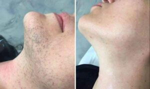 Why PCOS Changes What to Expect From Laser Hair Removal Results
