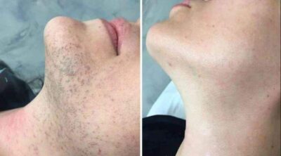 Why PCOS Changes What to Expect From Laser Hair Removal Results