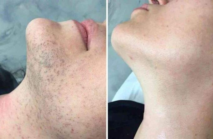 Why PCOS Changes What to Expect From Laser Hair Removal Results